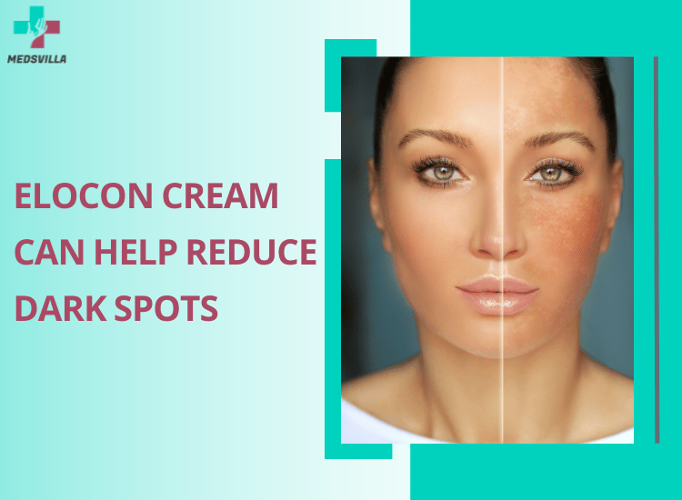 Elocon Cream